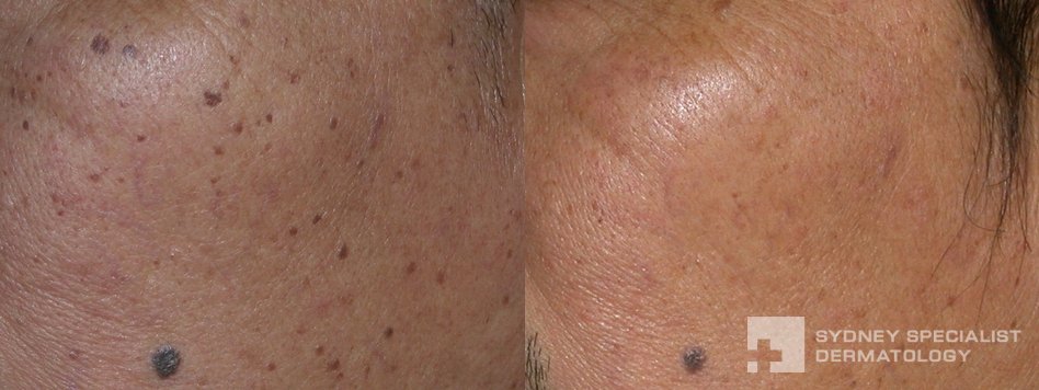 dermatosis papulosa nigra removal